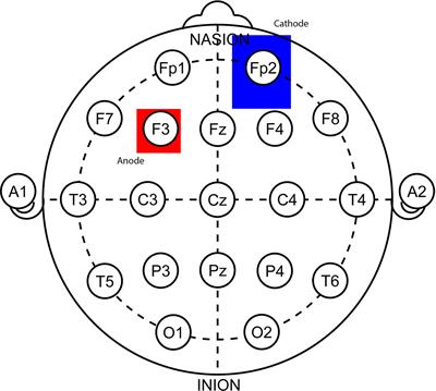 The Onset of Diabetes During Transcranial Direct Current Stimulation Treatment of Anorexia Nervosa — A Case Report